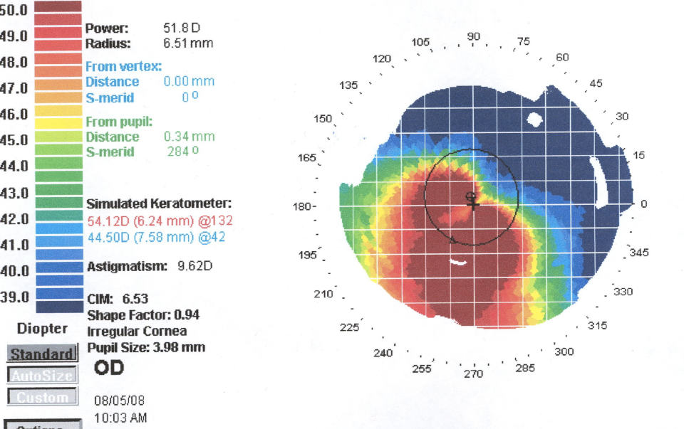 Признаки кератоконуса на топограмме роговицы